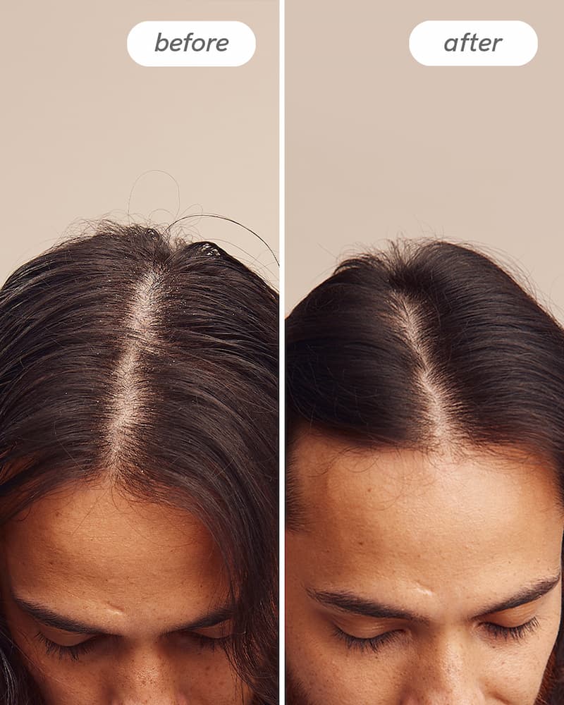 Instant Relief™ Scalp Spray - Image 5